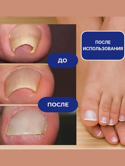 FORTERA Пластырь от вросших ногтей на ногах, бежевый, фото 2