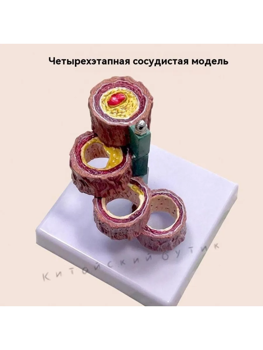 Анатомическая модель сосуда с атеросклерозом и тромбозом