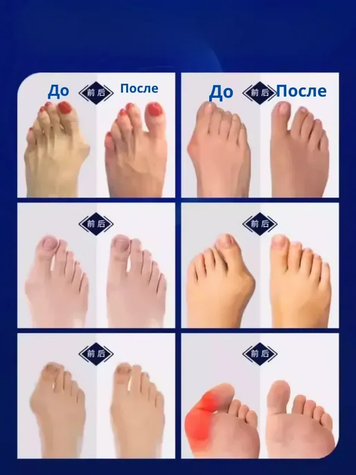датка7 Вальгусный корректор большого пальца ноги для косточки, белый, фото 3