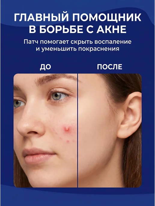 PATCHME Патчи от прыщей звездочки 40 шт, 40 шт, фото 2